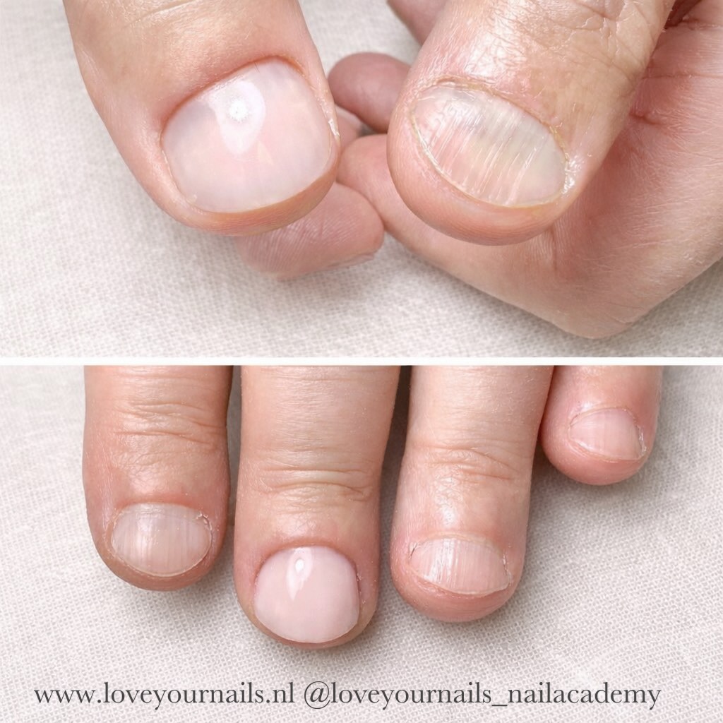 Praktijkvoorbeeld van nagelherstel bij nagelbijten